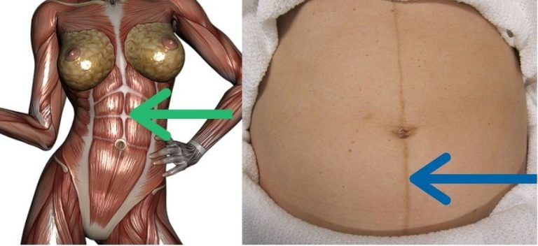 Linea alba vs linea negra - abdomen in sarcina