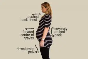 Hiperextensie lombara sarcina