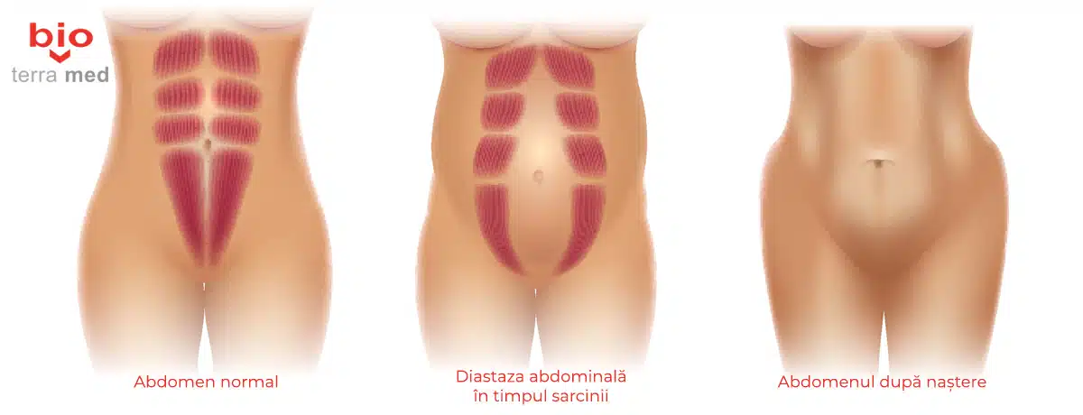 Abdomen normal, abdomen cu diastaza abdominala, si abdomen dupa nastere